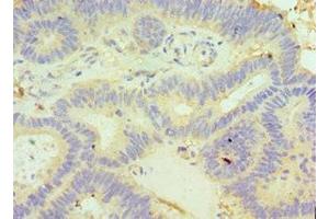 Immunohistochemistry of paraffin-embedded human colon cancer using ABIN7154051 at dilution of 1:100 (GLRX3 anticorps  (AA 1-335))