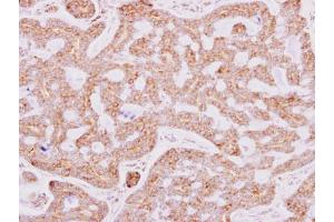 IHC-P Image RPL15 antibody detects RPL15 protein at cytosol on human breast carcinoma by immunohistochemical analysis. (RPL15 anticorps)