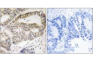 Immunohistochemistry analysis of paraffin-embedded human colon carcinoma tissue, using OSR1 (Ab-185) Antibody. (OSR1 anticorps  (AA 151-200))