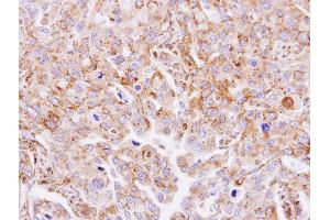 IHC-P Image Immunohistochemical analysis of paraffin-embedded SW480 xenograft, using MGAT3, antibody at 1:500 dilution.