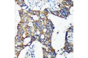 Immunohistochemistry of paraffin-embedded Human colon carcinoma using C18orf8 Rabbit pAb (ABIN7266379) at dilution of 1:100 (40x lens).