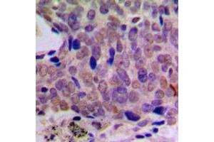 Immunohistochemical analysis of CREB staining in human breast cancer formalin fixed paraffin embedded tissue section.