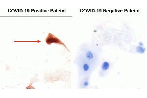 IHC Validation of SARS-CoV2 Spike in the Nasopharyngeal Swab Sample of the COVID-19 Patient.