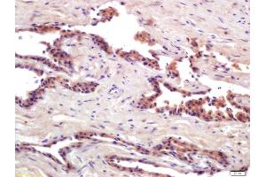 Formalin-fixed and paraffin embedded human prostate cancer labeled with Anti-PRSS8 Polyclonal Antibody, Unconjugated (ABIN761891) at 1:200 followed by conjugation to the secondary antibody and DAB staining (PRSS8 anticorps  (AA 65-165))