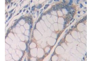 Detection of IL1R1 in Human Colorectal cancer Tissue using Polyclonal Antibody to Interleukin 1 Receptor Type I (IL1R1)