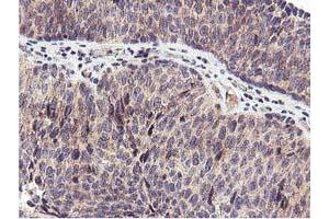 Immunohistochemical staining of paraffin-embedded Carcinoma of Human bladder tissue using anti-RFXANK mouse monoclonal antibody. (RFXANK anticorps)
