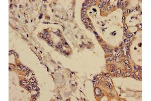 Immunohistochemistry of paraffin-embedded human pancreatic cancer using ABIN7145363 at dilution of 1:100