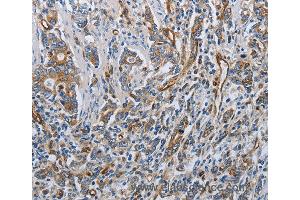 Immunohistochemistry of Human gastric cancer using SOCS1 Polyclonal Antibody at dilution of 1:70 (SOCS1 anticorps)