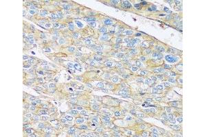 Immunohistochemistry of paraffin-embedded Human liver cancer using ARL4A Polyclonal Antibody at dilution of 1:100 (40x lens). (ARL4A anticorps)