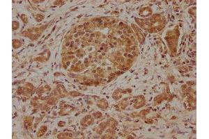 IHC image of ABIN7176698 diluted at 1:100 and staining in paraffin-embedded human pancreatic cancer performed on a Leica BondTM system.