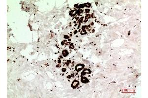Immunohistochemistry (IHC) analysis of paraffin-embedded Human Breast Cancer, antibody was diluted at 1:100.
