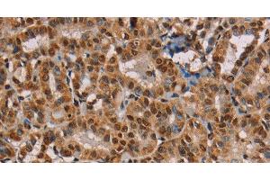 Immunohistochemistry of paraffin-embedded Human thyroid cancer using hnRNP G Polyclonal Antibody at dilution of 1:45 (RBMX anticorps)