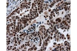 Immunohistochemical staining of paraffin-embedded Adenocarcinoma of breast tissue using anti-ACLY mouse monoclonal antibody. (ACLY anticorps)