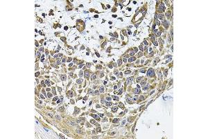 Immunohistochemistry of paraffin-embedded human skin carcinoma using ICOSL Antibody (ABIN6130065, ABIN6142131, ABIN6142132 and ABIN6222879) at dilution of 1:100 (40x lens). (ICOSLG anticorps  (AA 19-256))