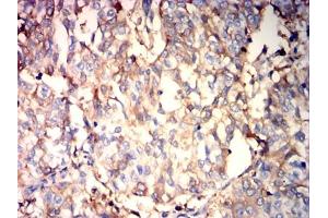 Immunohistochemical analysis of paraffin-embedded bladder cancer tissues using ALB mouse mAb with DAB staining. (Albumin anticorps  (AA 410-609))