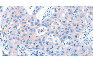 Immunohistochemistry of paraffin-embedded Human lung cancer tissue using NUAK1 Polyclonal Antibody at dilution 1:60 (NUAK1 anticorps)