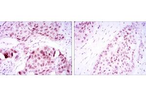 Immunohistochemical analysis of paraffin-embedded lung cancer tissues (left) and esophageal cancer tissues (right) using SOX2 mouse mAb with DAB staining.
