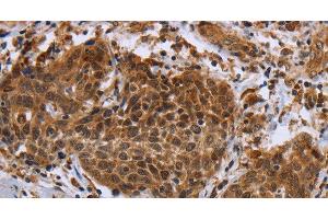 Immunohistochemistry of paraffin-embedded Human cervical cancer using DUSP8 Polyclonal Antibody at dilution of 1:30 (DUSP8 anticorps)