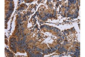 The image on the left is immunohistochemistry of paraffin-embedded Human colon cancer tissue using ABIN7130044(KRT31 Antibody) at dilution 1/30, on the right is treated with fusion protein. (Keratin 31 anticorps)