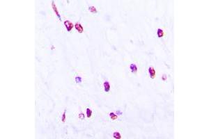 Immunohistochemical analysis of CDC25C (pS216) staining in human lung cancer formalin fixed paraffin embedded tissue section. (CDC25C anticorps  (pSer216))
