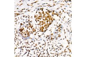Immunohistochemistry of paraffin-embedded human cervix cancer using Phospho-POLR2A CTD-S2 Rabbit mAb  at dilution of 1:200 (40x lens). (POLR2A/RPB1 anticorps  (pSer2))