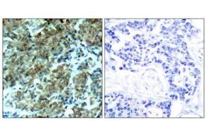 Immunohistochemical analysis of paraffin-embedded human breast carcinoma tissue, using Cortactin (Ab-466) antibody (E021264). (Cortactin anticorps)