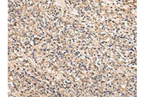 The image on the left is immunohistochemistry of paraffin-embedded Human prostate cancer tissue using ABIN7128011(SERPINA7 Antibody) at dilution 1/25, on the right is treated with fusion protein. (SERPINA7 anticorps)