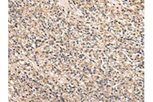 The image on the left is immunohistochemistry of paraffin-embedded Human prostate cancer tissue using ABIN7128011(SERPINA7 Antibody) at dilution 1/25, on the right is treated with fusion protein. (SERPINA7 anticorps)