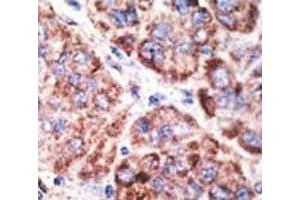 IHC analysis of FFPE human hepatocarcinoma tissue stained with the TLR6 antibody (TLR6 anticorps  (AA 1-30))