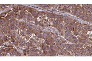 ABIN6277662 at 1/100 staining Human liver cancer tissue by IHC-P. (LSP1 anticorps  (C-Term))