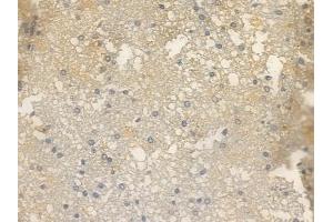 Phospho-mGluR5 (Ser870) Antibody at 1/100 staining human glioblastoma by IHC-P. (Metabotropic Glutamate Receptor 5 anticorps  (pSer870))