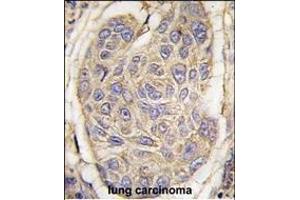 Formalin-fixed and paraffin-embedded human lung carcinoma tissue reacted with B2M antibody (C-term) (ABIN389259 and ABIN2839397) , which was peroxidase-conjugated to the secondary antibody, followed by DAB staining. (beta-2 Microglobulin anticorps  (C-Term))