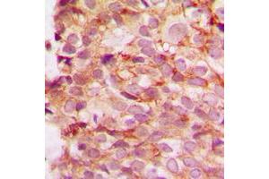Immunohistochemical analysis of Collagen 4 alpha 1 staining in human breast cancer formalin fixed paraffin embedded tissue section.