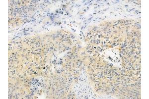 ABIN6264850 and ABIN6279033 at 1/100 staining human lung squamous cell carcinoma by IHC-P.