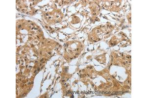 Immunohistochemistry of Human lung cancer using AMPH Polyclonal Antibody at dilution of 1:30 (Amphiphysin anticorps)