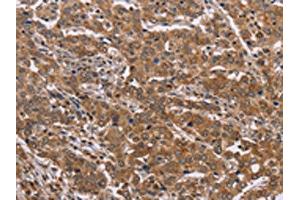 The image on the left is immunohistochemistry of paraffin-embedded Human liver cancer tissue using ABIN7129424(FAAH2 Antibody) at dilution 1/30, on the right is treated with fusion protein. (FAAH2 anticorps)