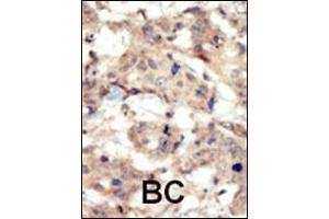 Formalin-fixed and paraffin-embedded human cancer tissue reacted with the primary antibody, which was peroxidase-conjugated to the secondary antibody, followed by DAB staining. (EPH Receptor B6 anticorps  (N-Term))