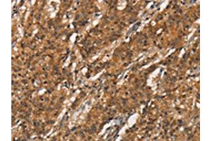 The image on the left is immunohistochemistry of paraffin-embedded Human gastric cancer tissue using ABIN7189855(APOC4 Antibody) at dilution 1/20, on the right is treated with synthetic peptide. (APOC4 anticorps)