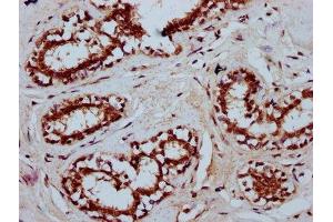 IHC image of ABIN7173536 diluted at 1:400 and staining in paraffin-embedded human breast cancer performed on a Leica BondTM system. (TSEN15 anticorps  (AA 1-171))