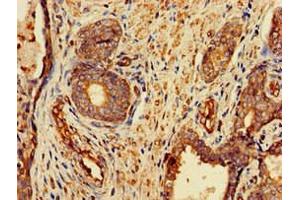 Immunohistochemistry of paraffin-embedded human prostate cancer using ABIN7153175 at dilution of 1:100 (FZD1 anticorps  (AA 73-322))