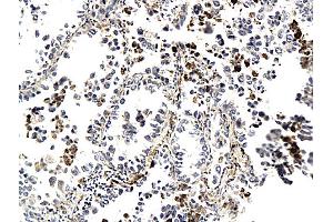 Formalin-fixed and paraffin embedded human lung cancer labeled with Anti-CK7 (Human) Polyclonal Antibody, Unconjugated (ABIN732023) followed by conjugation to the secondary antibody and DAB staining (Cytokeratin 7 anticorps  (AA 251-350))