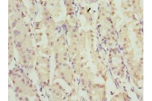 Immunohistochemistry of paraffin-embedded human gastric cancer using ABIN7176368 at dilution of 1:100 (ZNF549 anticorps  (AA 1-280))