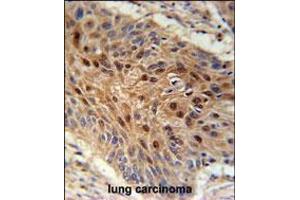 C4orf31 Antibody immunohistochemistry analysis in formalin fixed and paraffin embedded human lung carcinoma followed by peroxidase conjugation of the secondary antibody and DAB staining.