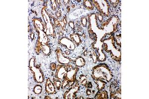 Anti-Tollip antibody, IHC(P) IHC(P): Human Prostatic Cancer Tissue (TOLLIP anticorps  (C-Term))