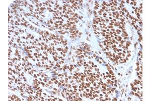 Formalin-fixed, paraffin-embedded human Breast Carcinoma stained with Estrogen Receptor alpha Mouse Monoclonal Antibody (ESR1/3557).