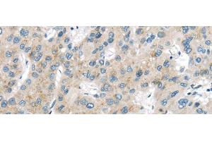 Immunohistochemistry of paraffin-embedded Human liver cancer using VPS26A Polyclonal Antibody at dilution of 1/40