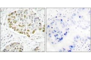 Immunohistochemistry analysis of paraffin-embedded human lung carcinoma tissue, using STAT5A (Ab-725) Antibody. (STAT5A anticorps  (AA 696-745))