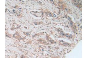 IHC-P analysis of Human Breast Cancer Tissue, with DAB staining. (AKT3 anticorps  (AA 46-338))