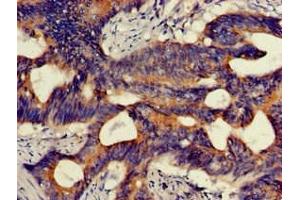 Immunohistochemistry of paraffin-embedded human colon cancer using ABIN7163904 at dilution of 1:100 (HMBS anticorps  (AA 283-330))
