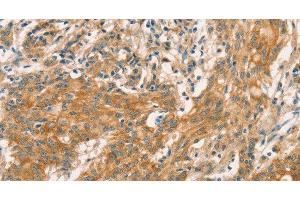 Immunohistochemistry of paraffin-embedded Human gastric cancer tissue using CPA2 Polyclonal Antibody at dilution 1:40 (Carboxypeptidase A2 anticorps)